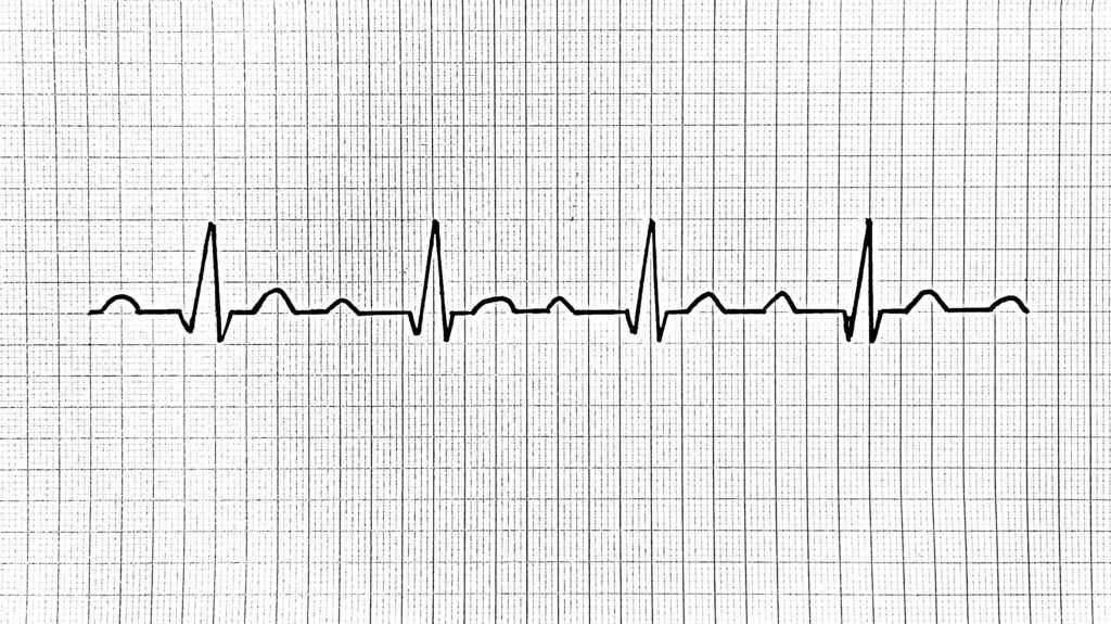 Ensimmäisen asteen AV-katkos ekg first degree av block ecg första gradens av-block ekg
