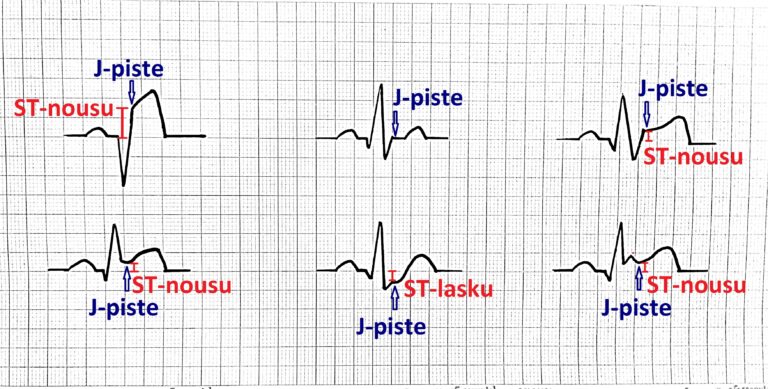 EKG PQRST J-pisteet ST-nousut ST-laskut