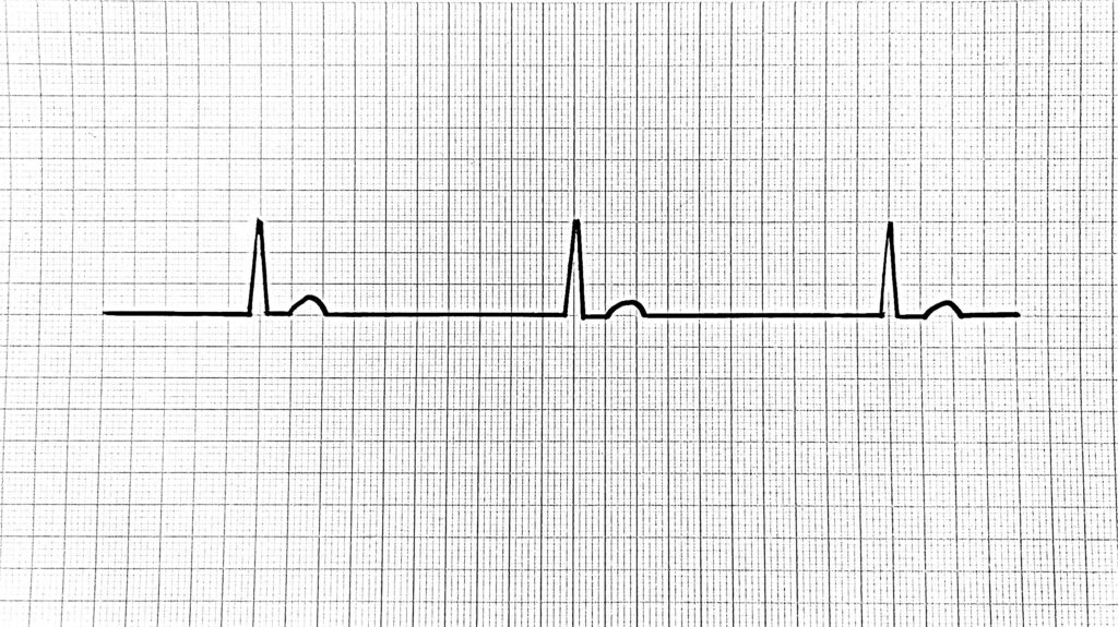 Junktionaalinen rytmi nodal rytm nodal rhythm