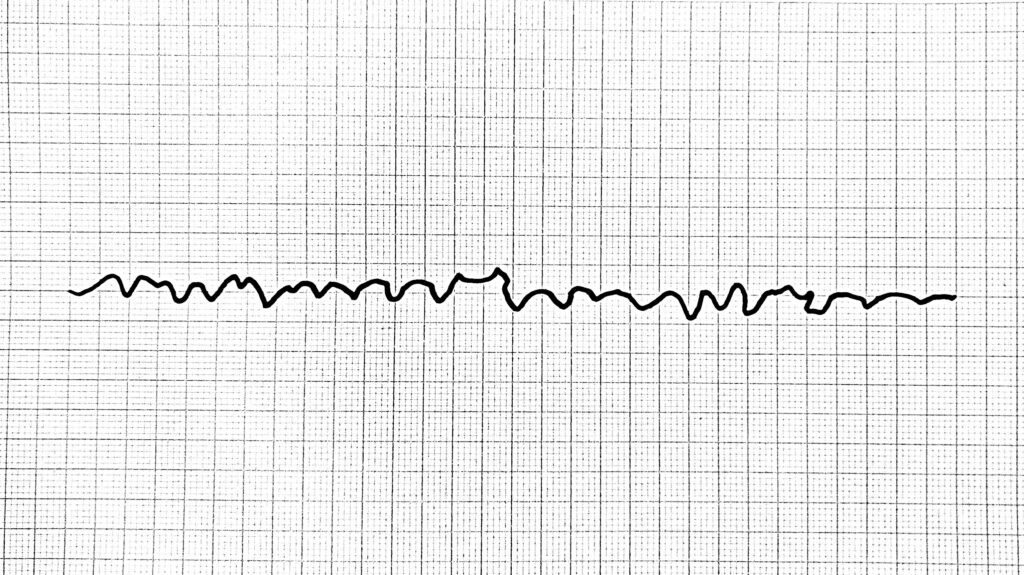 VF ventricular fibrillation kammiovärinä kammarflimmer EKG ECG